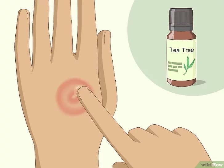 CÓMO CURAR UN HONGO O TIÑA EN LA PIEL